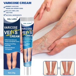 crema vene varicose